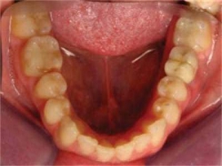   The implant was restored with a porcelain bonded crown and abutment.  