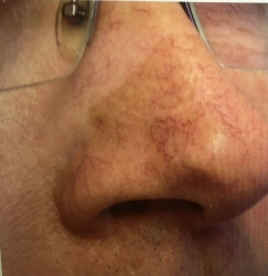 red veins on the face can be treated at the
salon