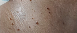 skin tags can be treated at the salon