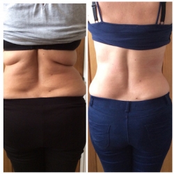 Liposculpt Results from a 10 Treatment Course